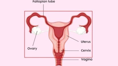 Radical hysterectomy