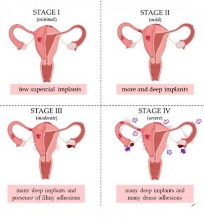 Stages of Endometriosis