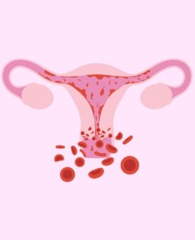Heavy or Prolonged Menstrual Bleeding