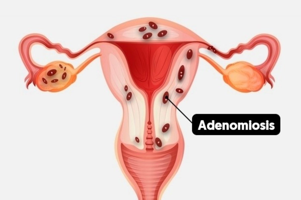 Adenomyosis treatment