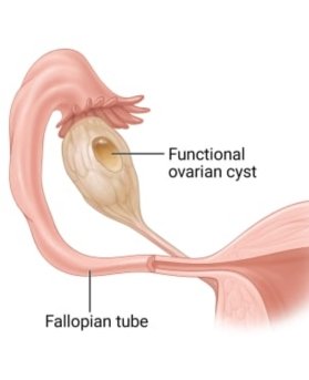 Functional Cysts