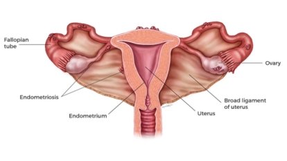 Endometriomas