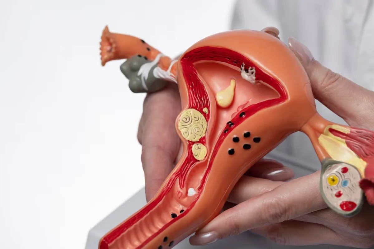 Ovarian Cysts Treatment