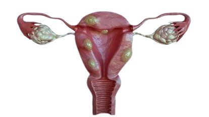 Adenomyosis