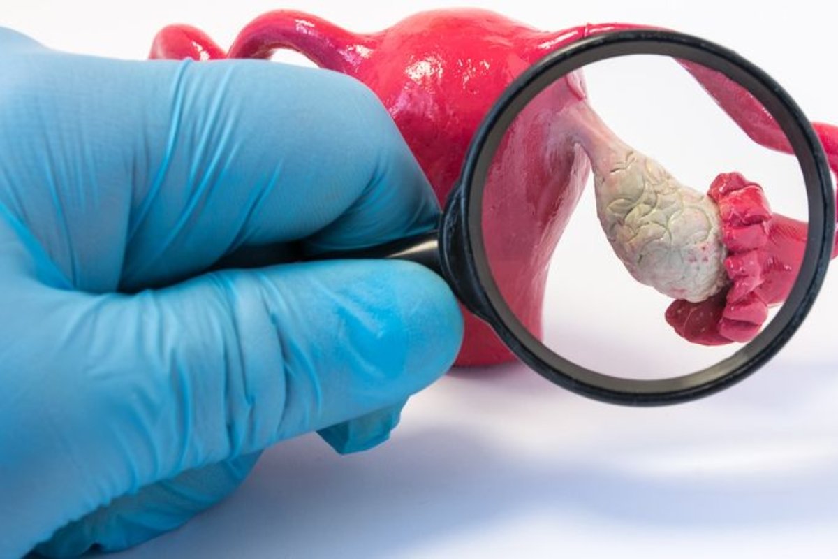 Ovarian Torsion Treatment