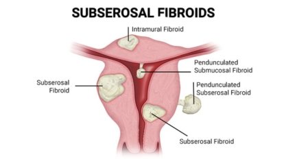 Subserosal Fibroids