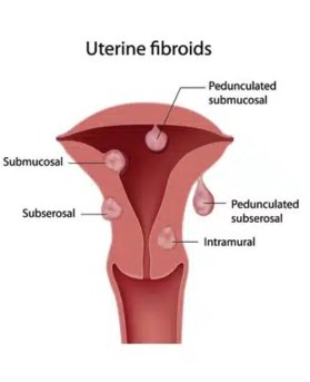 Submucosal Fibroids