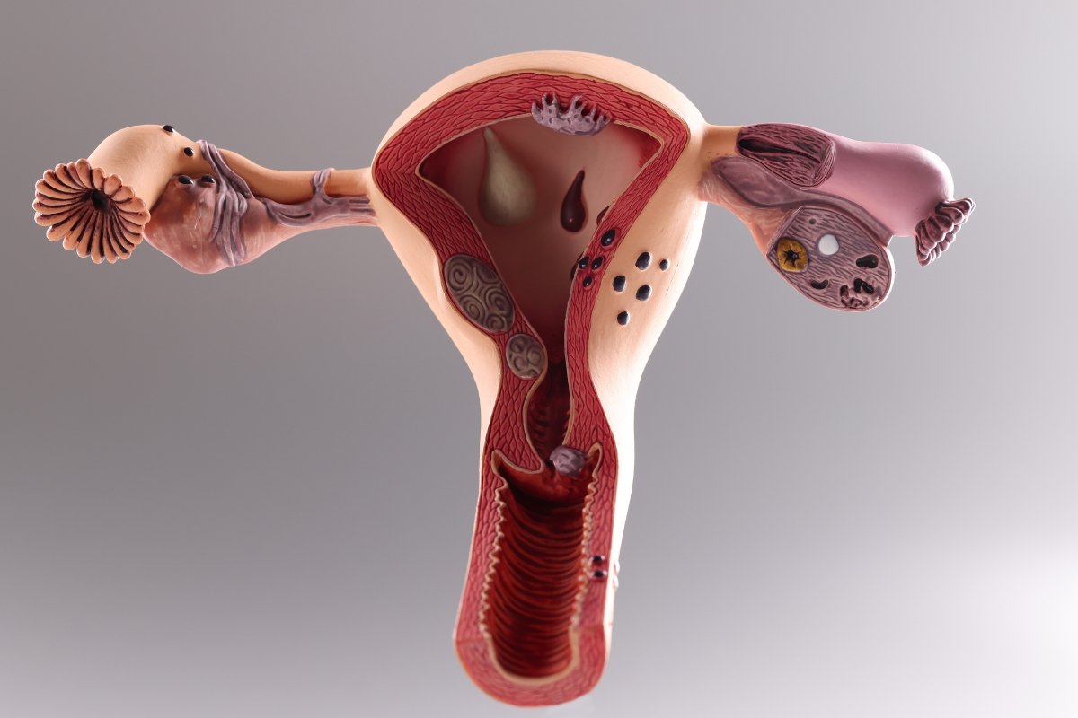 Uterine Fibroids